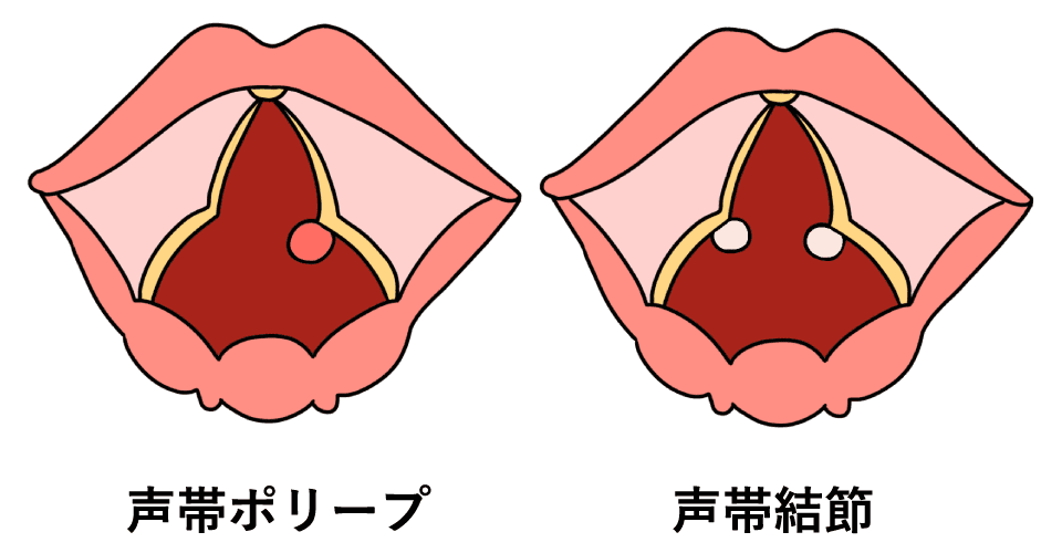 声帯ポリープ・声帯結節